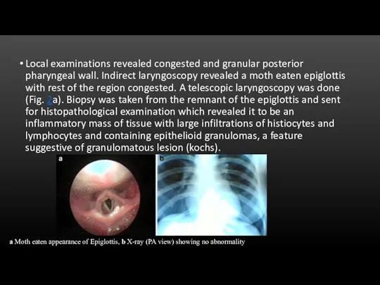 Local examinations revealed congested and granular posterior pharyngeal wall. Indirect