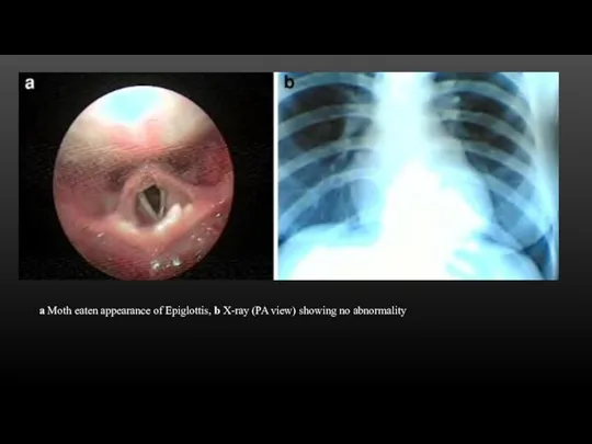 a Moth eaten appearance of Epiglottis, b X-ray (PA view) showing no abnormality