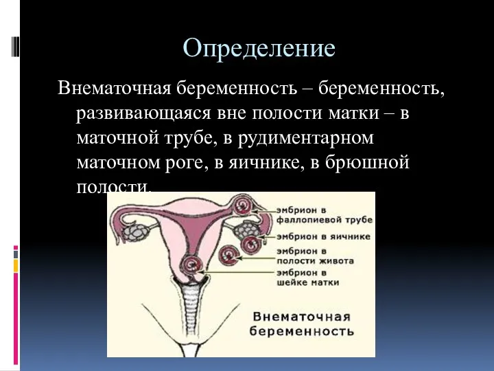 Определение Внематочная беременность – беременность, развивающаяся вне полости матки –