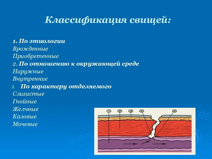 Классификация свищей: 1. По этиологии Врожденные Приобретенные 2. По отношению