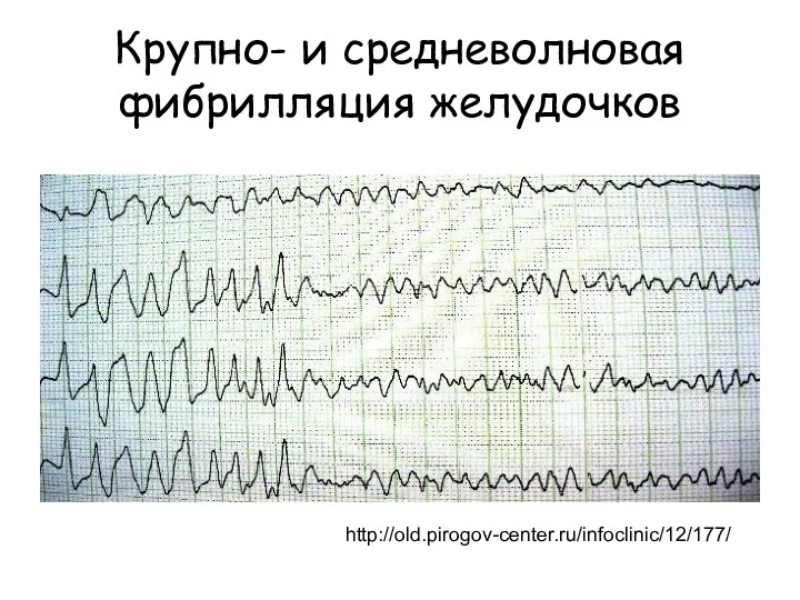 Крупно- и средневолновая фибрилляция желудочков http://old.pirogov-center.ru/infoclinic/12/177/