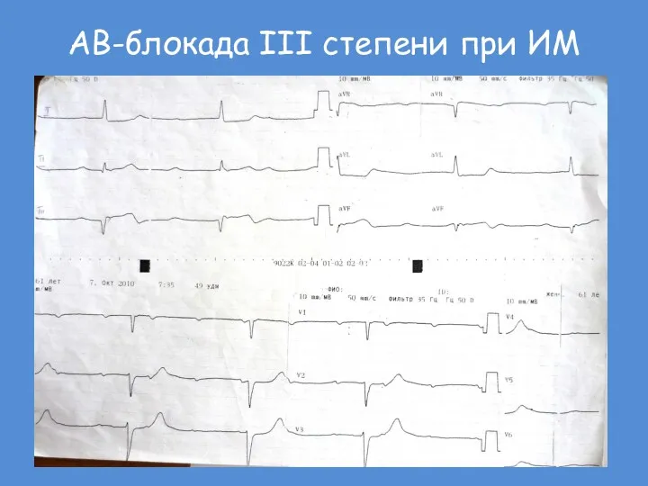 АВ-блокада III степени при ИМ