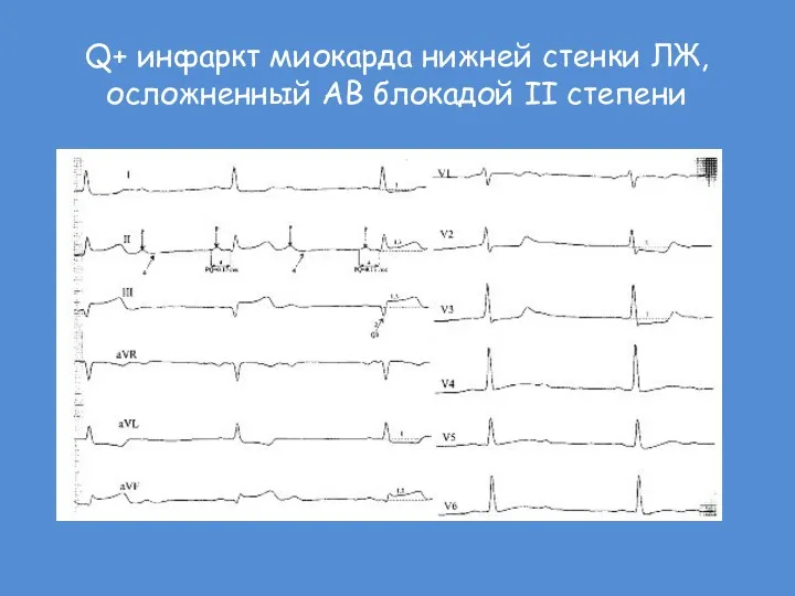 Q+ инфаркт миокарда нижней стенки ЛЖ, осложненный АВ блокадой II степени