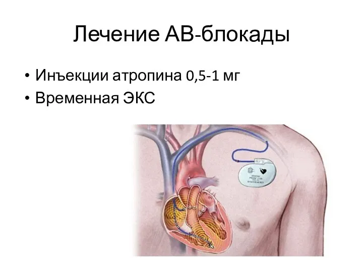 Лечение АВ-блокады Инъекции атропина 0,5-1 мг Временная ЭКС