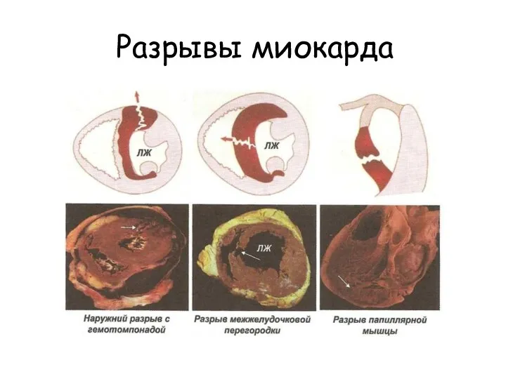 Разрывы миокарда