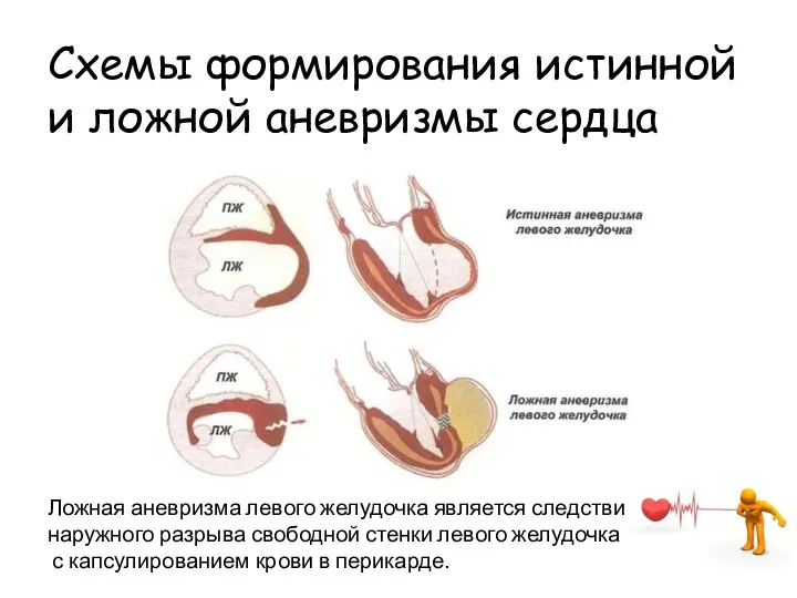 Схемы формирования истинной и ложной аневризмы сердца Ложная аневризма левого