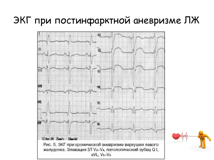 ЭКГ при постинфарктной аневризме ЛЖ