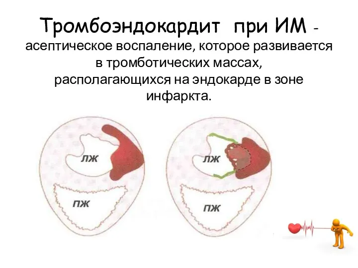 Тромбоэндокардит при ИМ -асептическое воспаление, которое развивается в тромботических массах, располагающихся на эндокарде в зоне инфаркта.