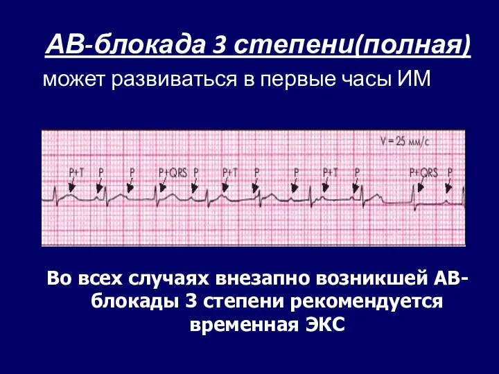 АВ-блокада 3 степени(полная) может развиваться в первые часы ИМ Во