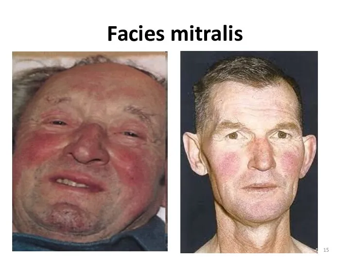 Facies mitralis