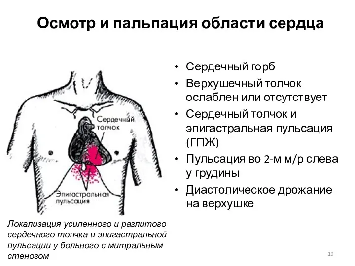 Осмотр и пальпация области сердца Сердечный горб Верхушечный толчок ослаблен