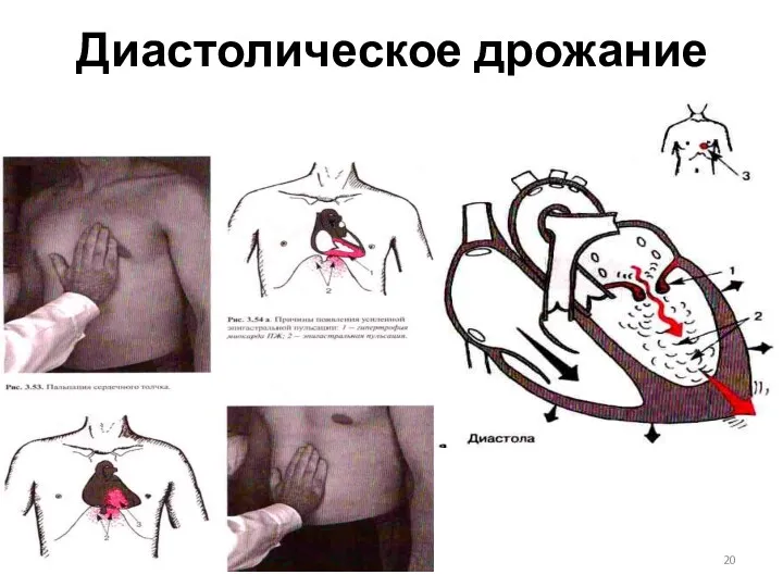 Диастолическое дрожание