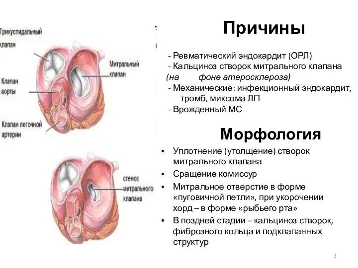 Причины - Ревматический эндокардит (ОРЛ) - Кальциноз створок митрального клапана