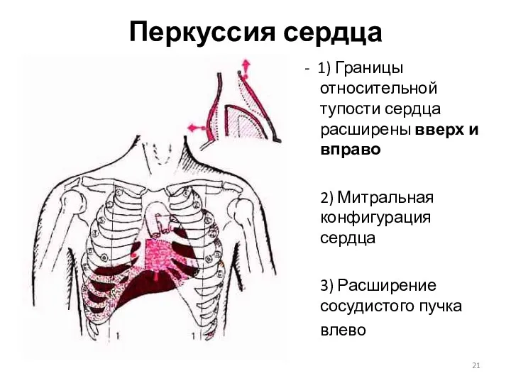 Перкуссия сердца - 1) Границы относительной тупости сердца расширены вверх