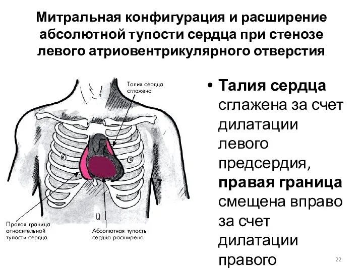 Митральная конфигурация и расширение абсолютной тупости сердца при стенозе левого