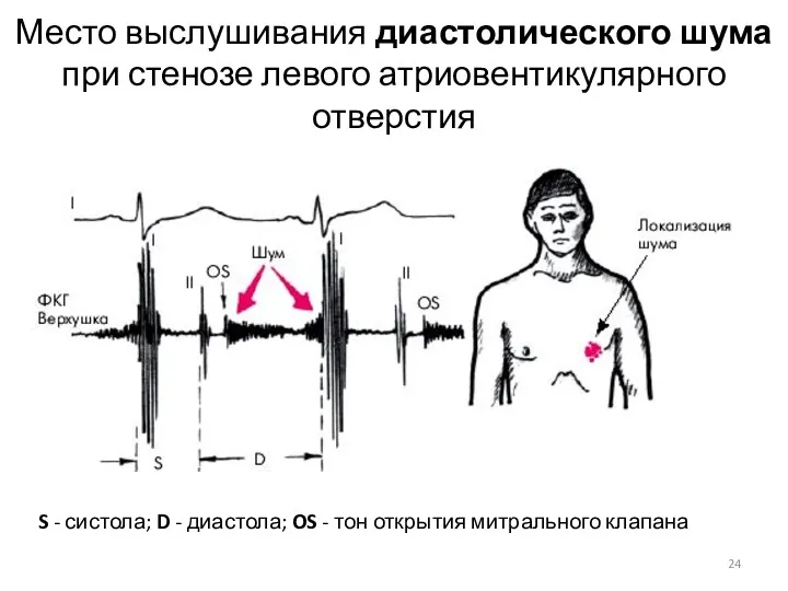 Место выслушивания диастолического шума при стенозе левого атриовентикулярного отверстия S