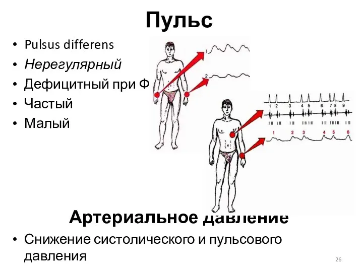 Пульс Pulsus differens Нерегулярный Дефицитный при ФП Частый Малый Артериальное давление Снижение систолического и пульсового давления