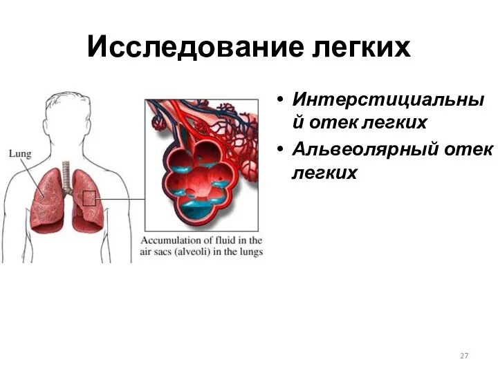 Исследование легких Интерстициальный отек легких Альвеолярный отек легких