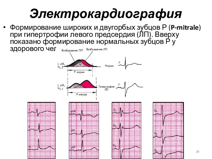 Электрокардиография Формирование широких и двугорбых зубцов Р (P-mitrale) при гипертрофии
