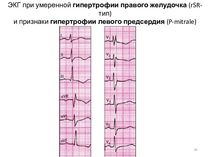 ЭКГ при умеренной гипертрофии правого желудочка (rSR-тип) и признаки гипертрофии левого предсердия (P-mitrale)