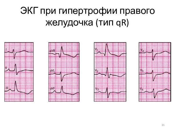 ЭКГ при гипертрофии правого желудочка (тип qR)