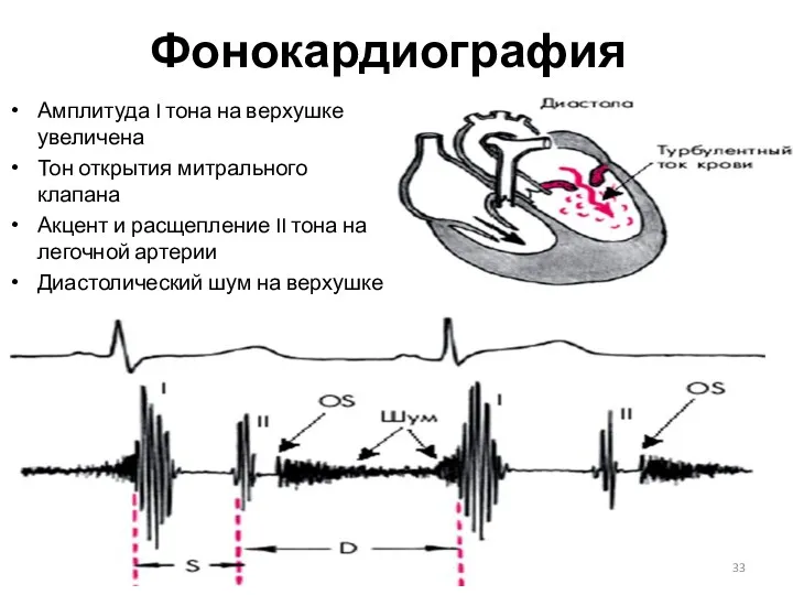 Фонокардиография Амплитуда I тона на верхушке увеличена Тон открытия митрального