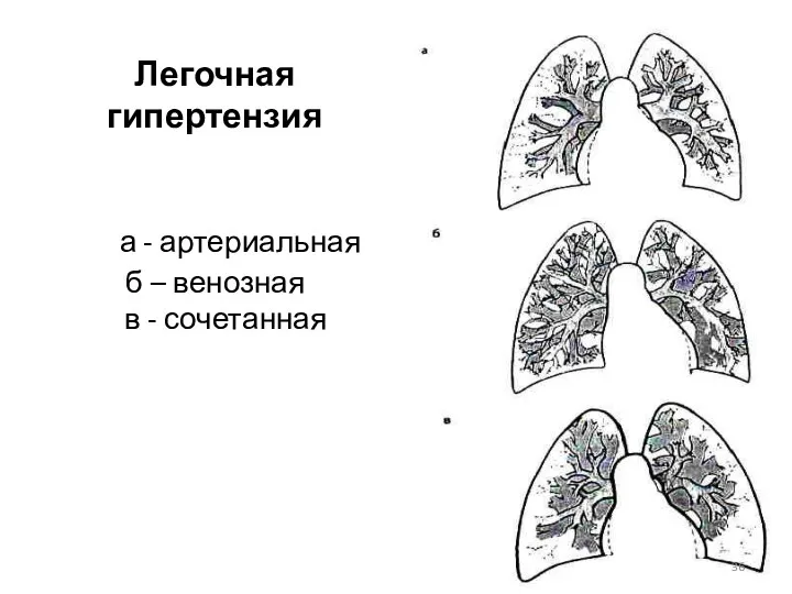 Легочная гипертензия а - артериальная б – венозная в - сочетанная