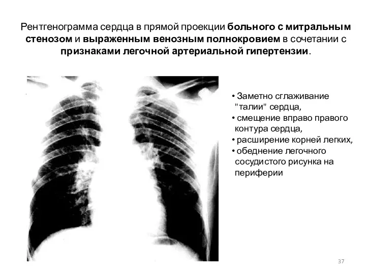 Рентгенограмма сердца в прямой проекции больного с митральным стенозом и