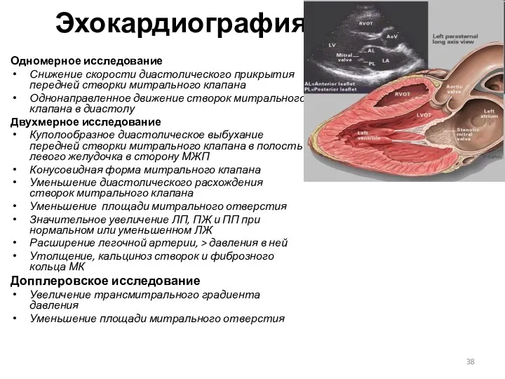 Эхокардиография Одномерное исследование Снижение скорости диастолического прикрытия передней створки митрального