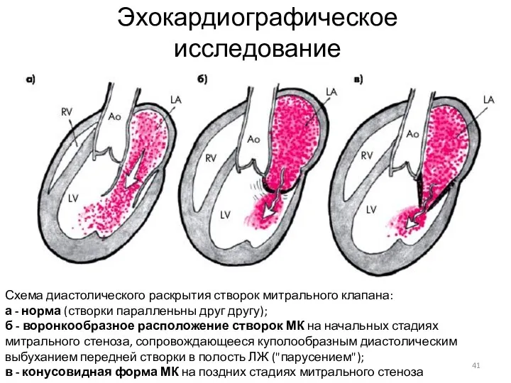 Эхокардиографическое исследование Схема диастолического раскрытия створок митрального клапана: а -