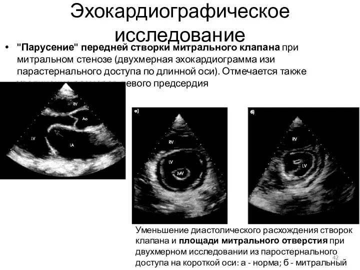 Эхокардиографическое исследование "Парусение" передней створки митрального клапана при митральном стенозе