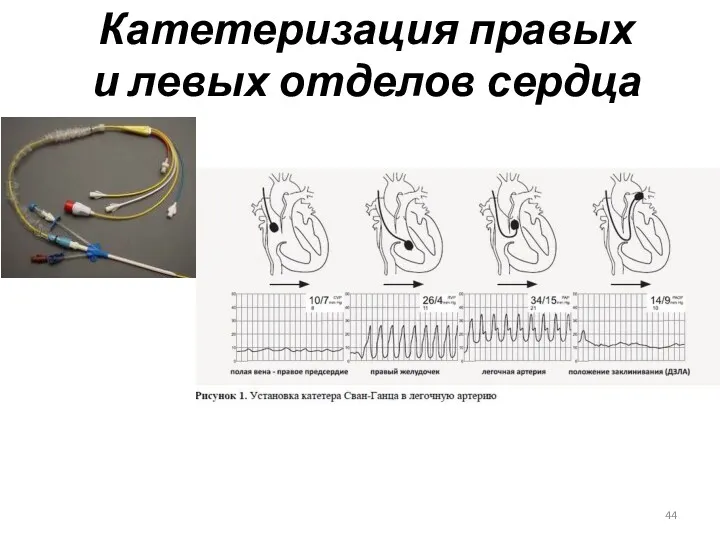 Катетеризация правых и левых отделов сердца