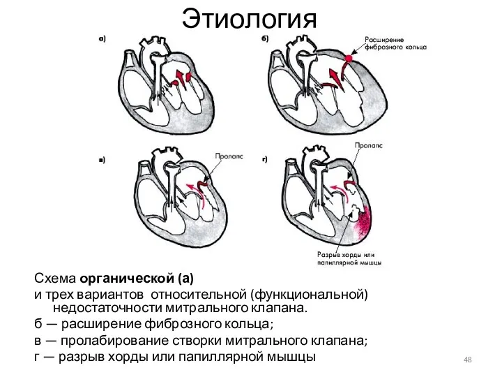 Этиология Схема органической (а) и трех вариантов относительной (функциональной) недостаточности