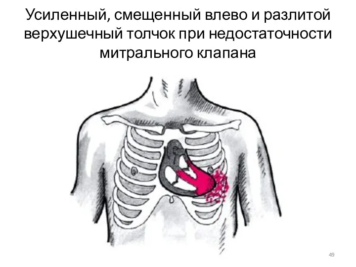 Усиленный, смещенный влево и разлитой верхушечный толчок при недостаточности митрального клапана