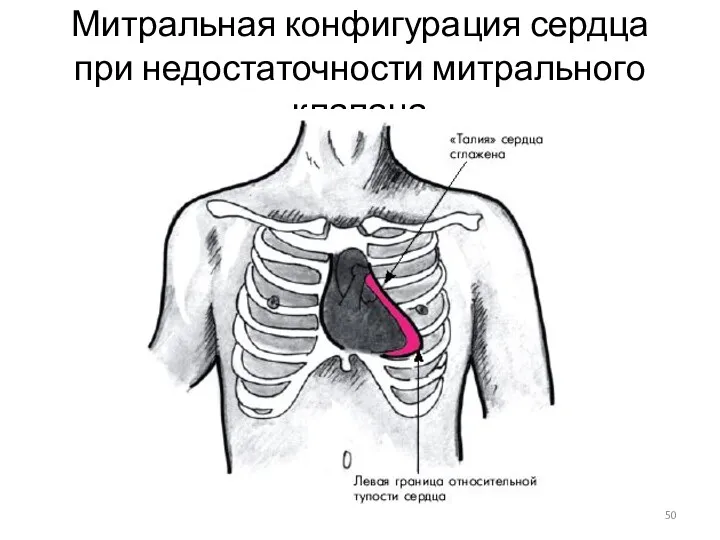 Митральная конфигурация сердца при недостаточности митрального клапана