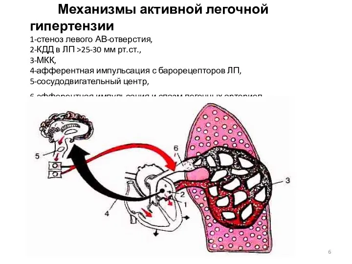 Механизмы активной легочной гипертензии 1-стеноз левого АВ-отверстия, 2-КДД в ЛП
