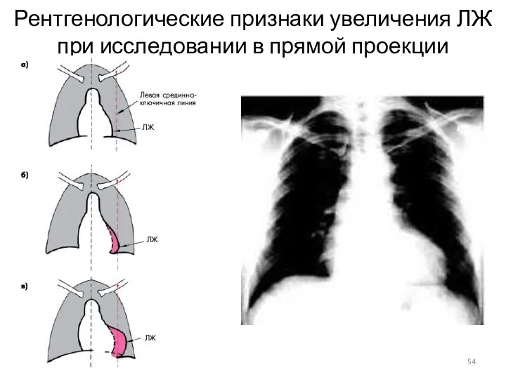 Рентгенологические признаки увеличения ЛЖ при исследовании в прямой проекции