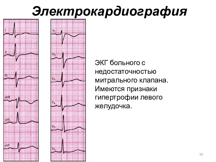 Электрокардиография ЭКГ больного с недостаточностью митрального клапана. Имеются признаки гипертрофии левого желудочка.
