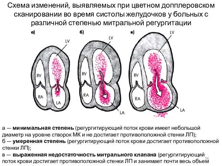 Схема изменений, выявляемых при цветном допплеровском сканировании во время систолы