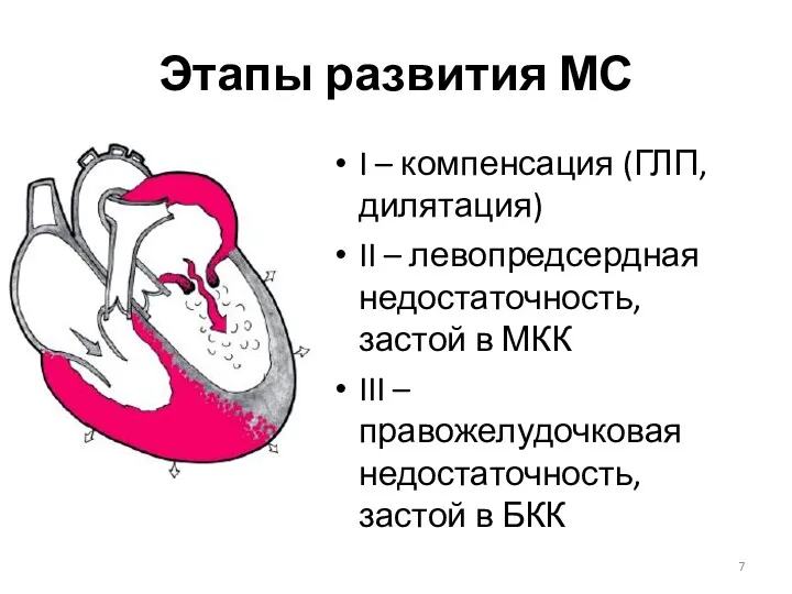 Этапы развития МС I – компенсация (ГЛП, дилятация) II –