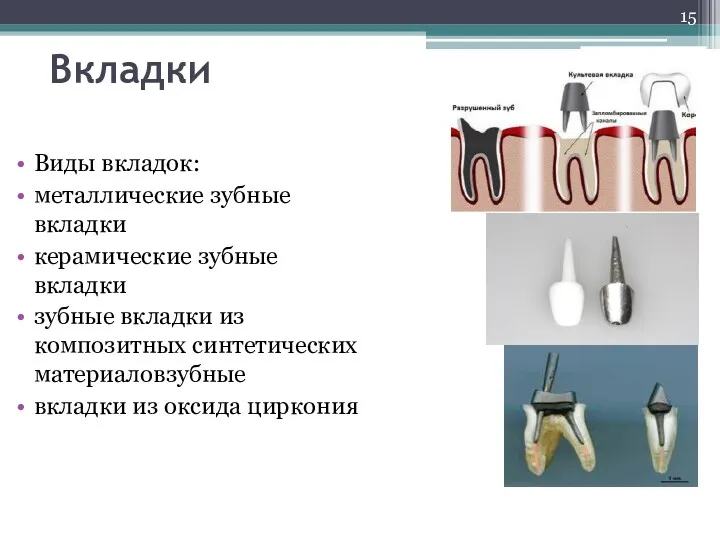 Вкладки Виды вкладок: металлические зубные вкладки керамические зубные вкладки зубные