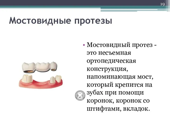 Мостовидные протезы Мостовидный протез - это несъемная ортопедическая конструкция, напоминающая