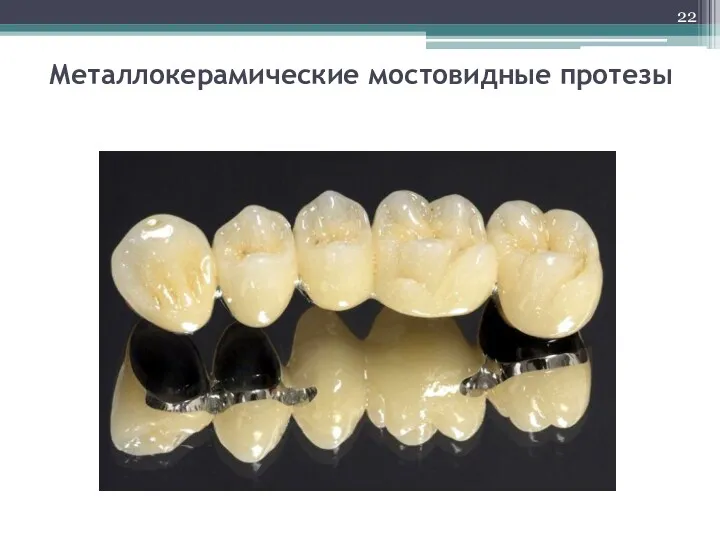Металлокерамические мостовидные протезы