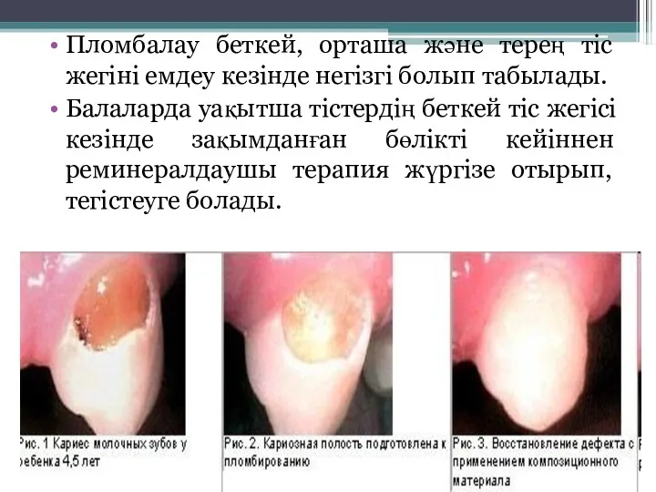 Пломбалау беткей, орташа және терең тіс жегіні емдеу кезінде негізгі