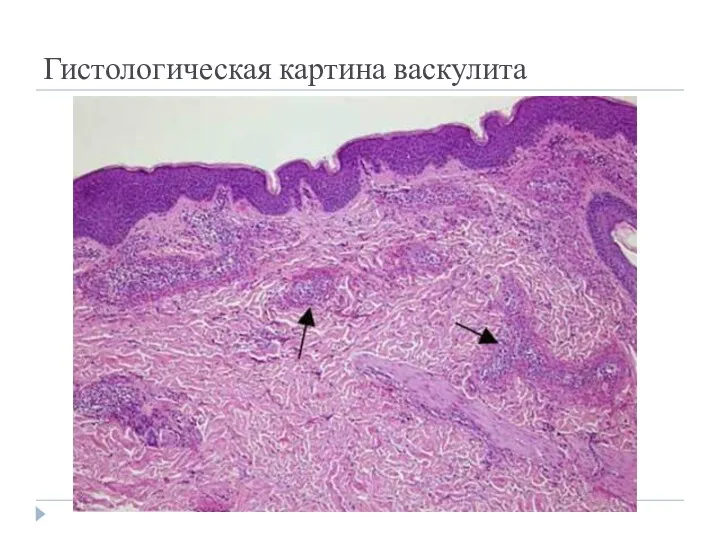 Гистологическая картина васкулита