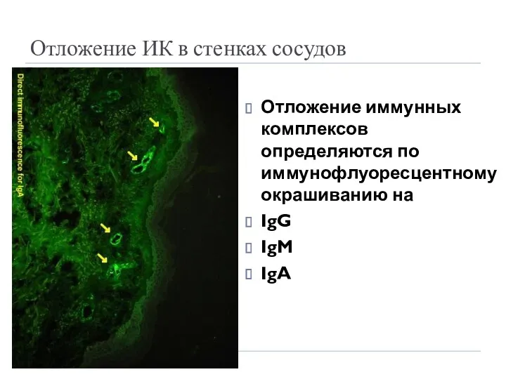 Отложение ИК в стенках сосудов Отложение иммунных комплексов определяются по иммунофлуоресцентному окрашиванию на IgG IgM IgA