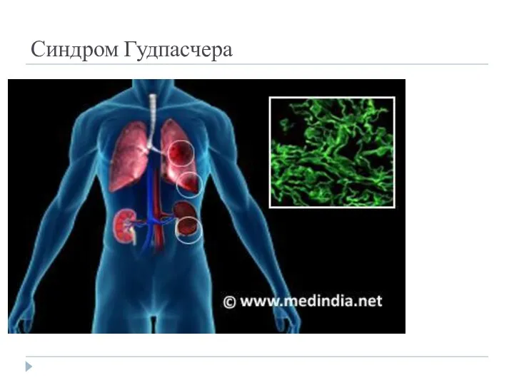 Синдром Гудпасчера мм