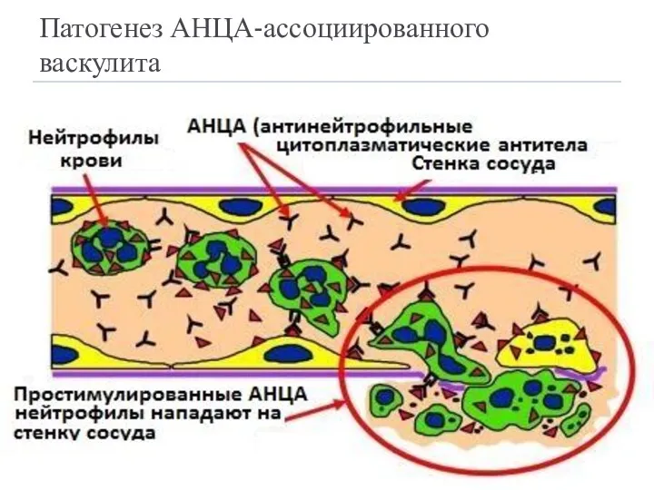 Патогенез АНЦА-ассоциированного васкулита