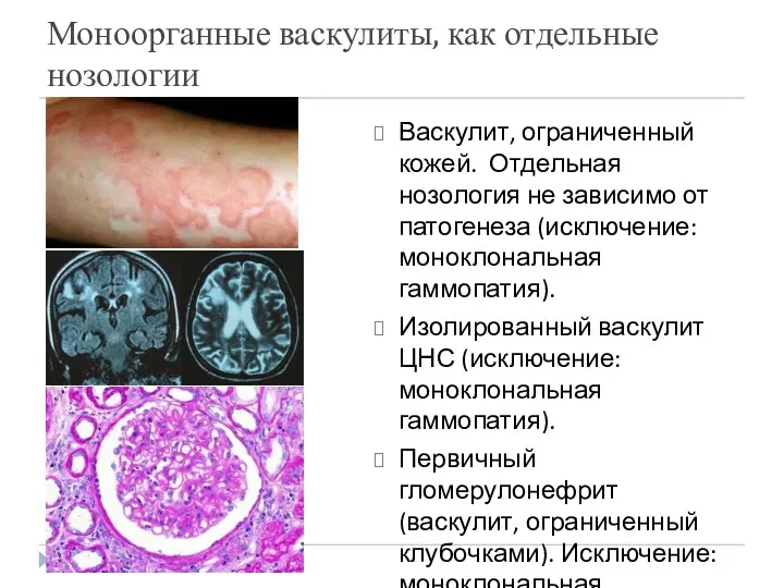 Моноорганные васкулиты, как отдельные нозологии Васкулит, ограниченный кожей. Отдельная нозология