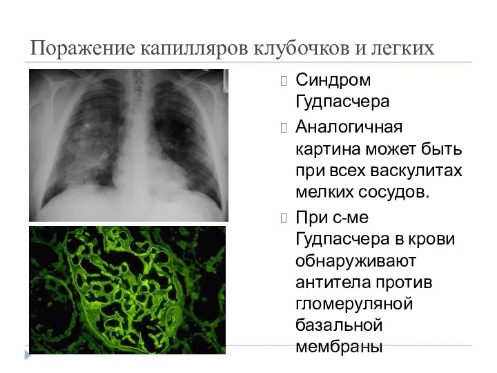 Поражение капилляров клубочков и легких Синдром Гудпасчера Аналогичная картина может